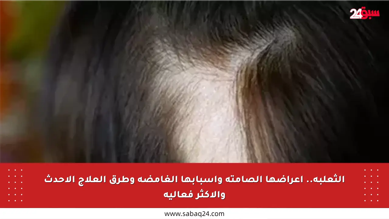 الثعلبة.. أعراضها الصامتة وأسبابها الغامضة وطرق العلاج الأحدث والأكثر فعالية